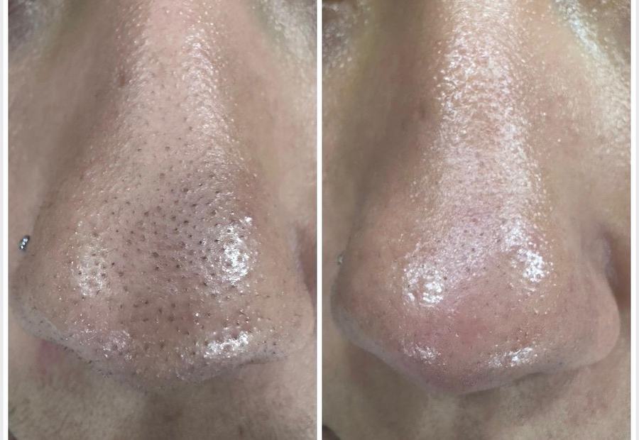 Limpieza facial