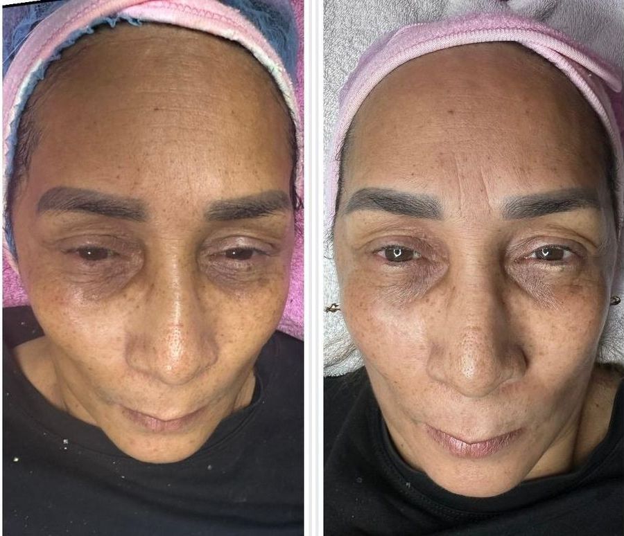 Tratamiento facial