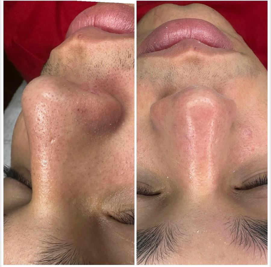 Limpieza facial