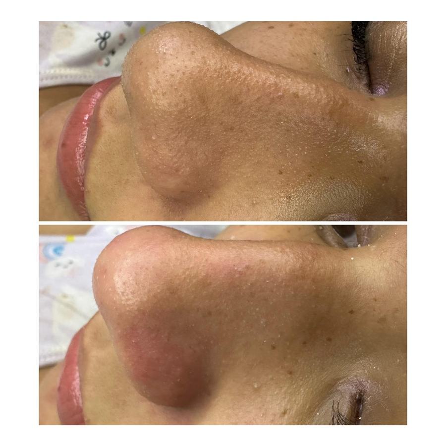 Limpieza facial