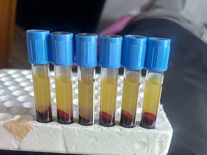 Plasma rico en plaquetas separado en tubos