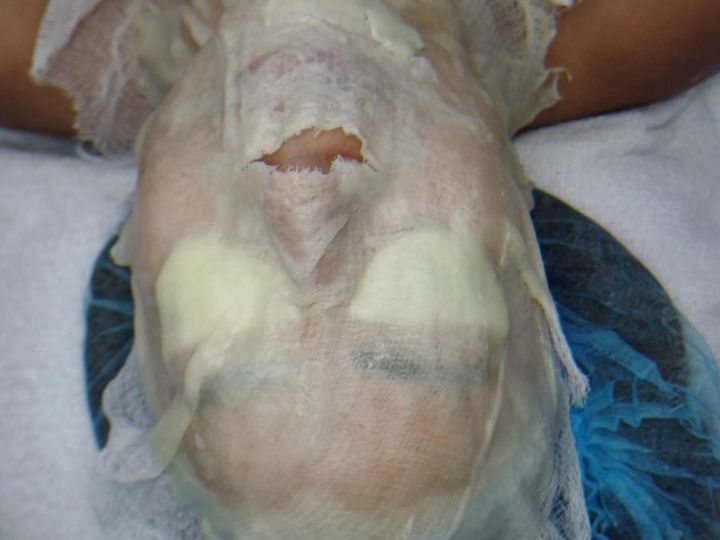 Mascarilla facial aplicada durante un tratamiento